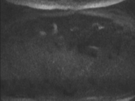 Adenocarcioma of rectum- T1 lesion (Radiopaedia 36921-38546 Axial DWI 82).png