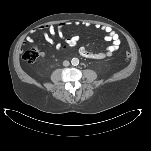 Adenocarcioma of rectum- T1 lesion (Radiopaedia 36921-38547 Axial C+ portal venous phase 51).png