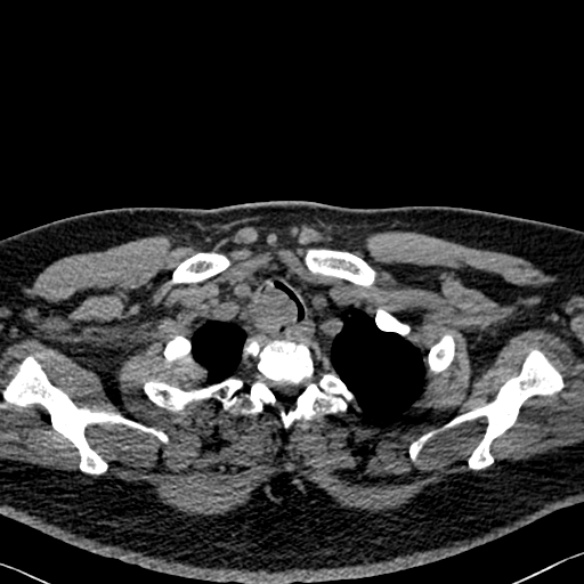 Adenoid cystic carcinoma of the trachea (Radiopaedia 49042-54137 Axial non-contrast 29).jpg