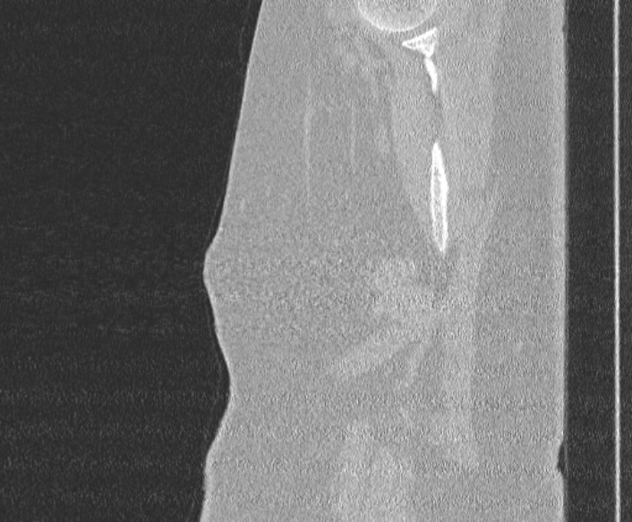 File:Adenoid cystic carcinoma of the trachea (Radiopaedia 49042-54137 Sagittal lung window 2).jpg