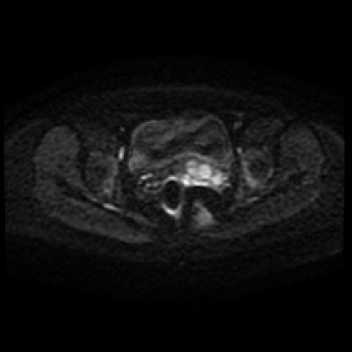 Adenoma malignum of cervix (Radiopaedia 66441-75705 Axial DWI 65).jpg