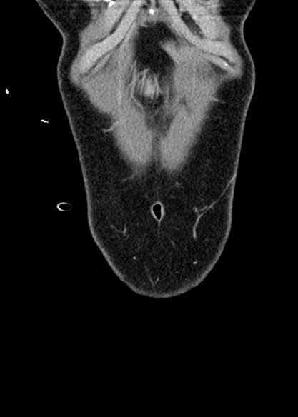Adhesional small bowel obstruction (Radiopaedia 48397-53305 Coronal C+ portal venous phase 31).jpg