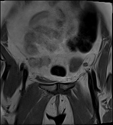 File:Adnexal multilocular cyst (O-RADS US 3- O-RADS MRI 3) (Radiopaedia 87426-103754 Coronal 7).jpg