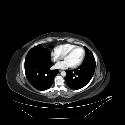 Adrenal angiosarcoma (Radiopaedia 81081-94671 Axial C+ arterial phase 1).jpg