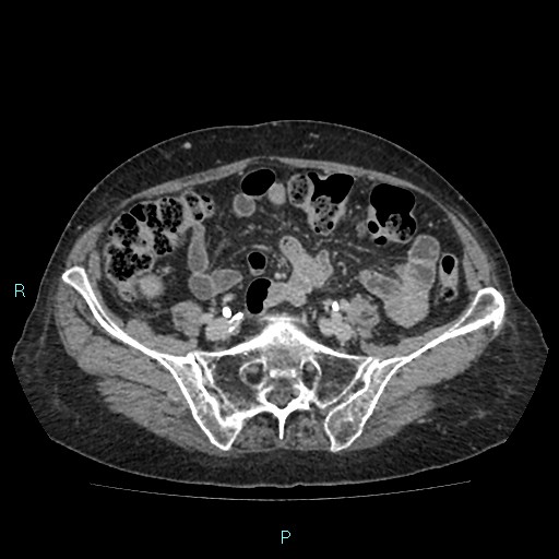 File:Adrenal collision tumor (ACT) (Radiopaedia 48462-53379 Axial C+ delayed 48).jpg
