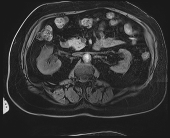 Adrenal cortical carcinoma (Radiopaedia 64017-72770 Axial T1 C+ fat sat 23).jpg
