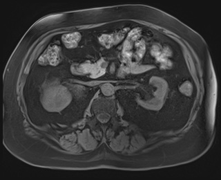 Adrenal cortical carcinoma (Radiopaedia 64017-72770 Axial T1 fat sat 40).jpg