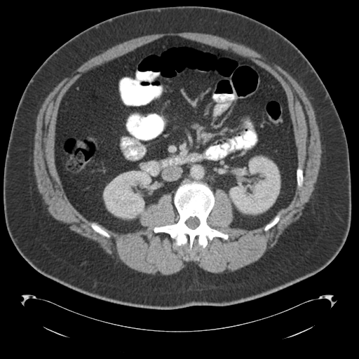 Adrenal cyst (Radiopaedia 45625-49776 Axial C+ portal venous phase 44).png