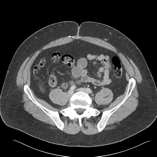 Adrenal cyst (Radiopaedia 45625-49777 Axial C+ portal venous phase 70).png