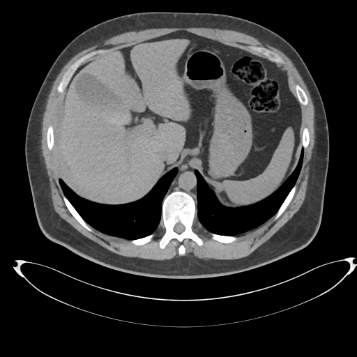 File:Adrenal cyst (Radiopaedia 45625-49778 Axial non-contrast 19).png