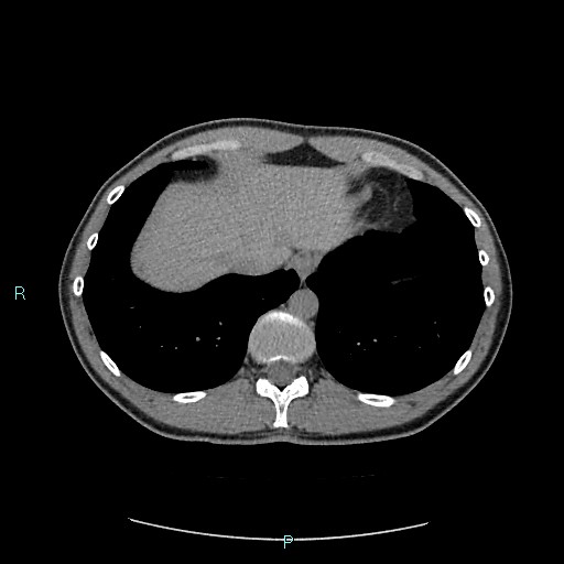 File:Adrenal cystic lymphangioma (Radiopaedia 83161-97534 Axial non-contrast 15).jpg