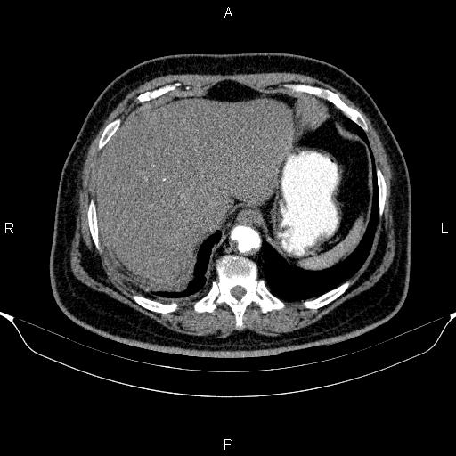 Adrenal hemorrhage (Radiopaedia 62622-70916 Axial C+ arterial phase 46).jpg