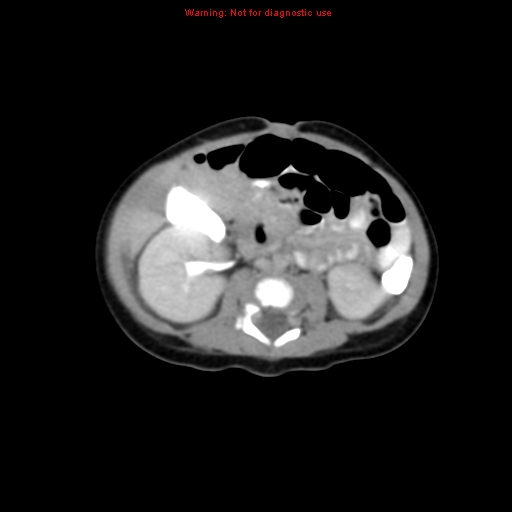 File:Adrenal hemorrhage (Radiopaedia 9390-10077 Axial C+ portal venous phase 19).jpg