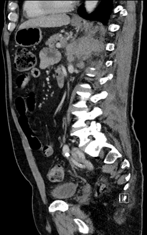 Adrenal lymphoma (Radiopaedia 73730-84529 Sagittal C+ portal venous phase 67).jpg