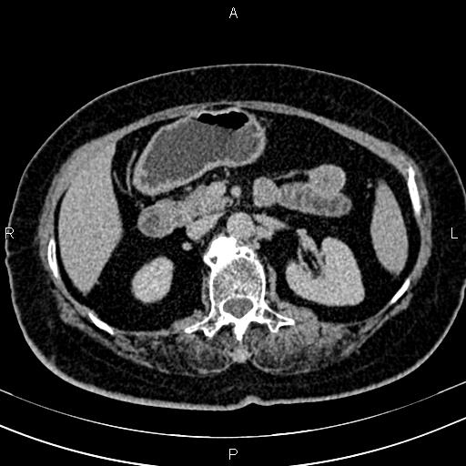 Adrenal myelolipoma (Radiopaedia 82742-96986 Axial renal excretory phase 54).jpg