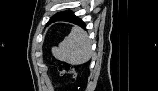 Adrenal myelolipoma (Radiopaedia 84321-99619 Sagittal non-contrast 99).jpg