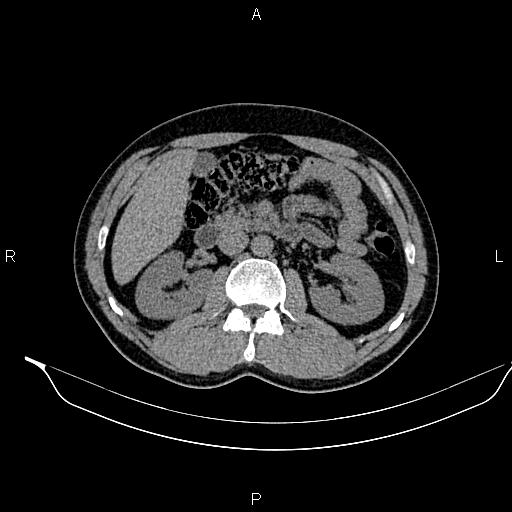 Adrenal myelolipoma (Radiopaedia 87794-104246 Axial non-contrast 44).jpg