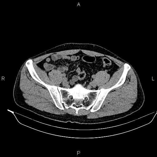 Adrenal myelolipoma (Radiopaedia 87794-104246 Axial non-contrast 83).jpg