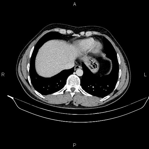 File:Adrenal myelolipoma (Radiopaedia 87794-104246 Axial renal cortical phase 13).jpg