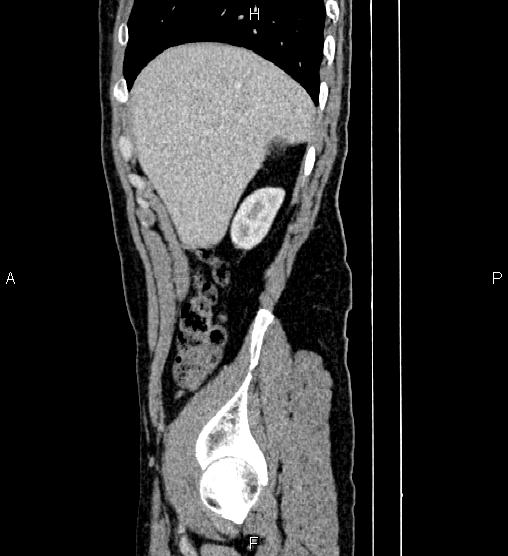 Adrenal myelolipoma (Radiopaedia 87794-104246 Sagittal renal cortical phase 16).jpg