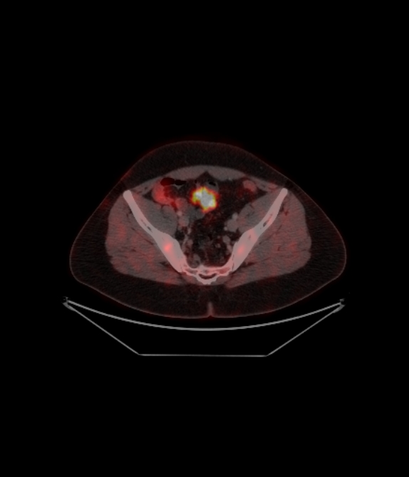 Adrenocortical carcinoma (Radiopaedia 80134-93440 ِAxial 229).jpg