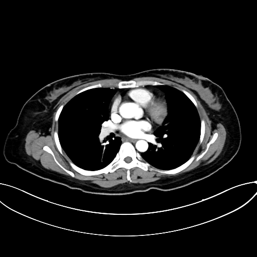 Adrenocortical carcinoma (Radiopaedia 87281-103569 Axial C+ arterial phase 1).jpg