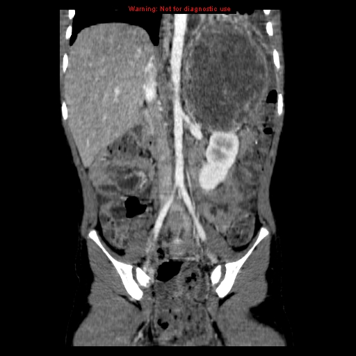 File:Adrenocortical carcinoma (Radiopaedia 9449-10131 Coronal C+ portal venous phase 9).jpg