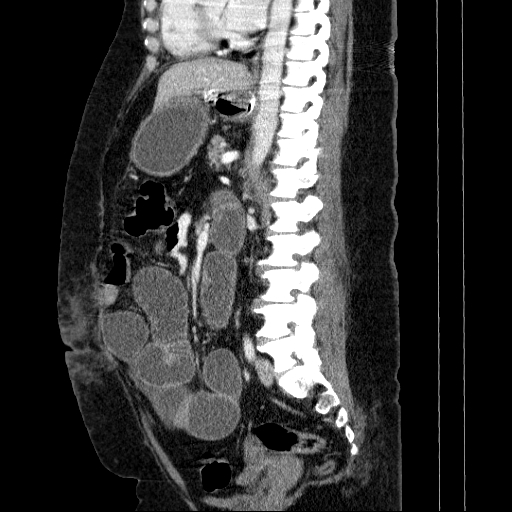 Afferent loop syndrome - secondary to incarcerated trocar site hernia (Radiopaedia 82959-97305 Sagittal C+ portal venous phase 69).jpg