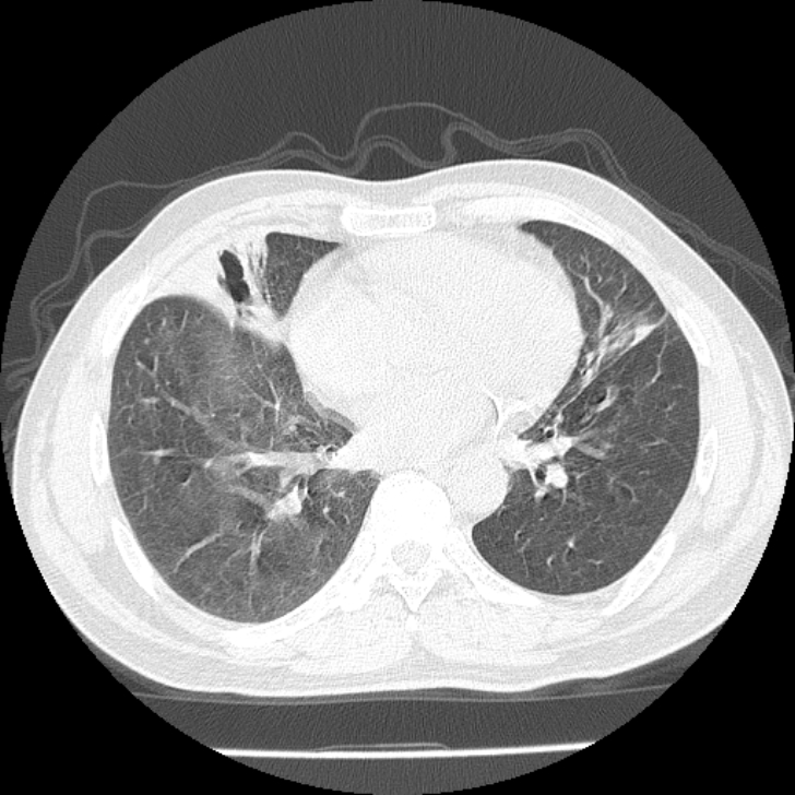 Airway foreign body in adult (Radiopaedia 85907-101779 Axial lung window 117).jpg