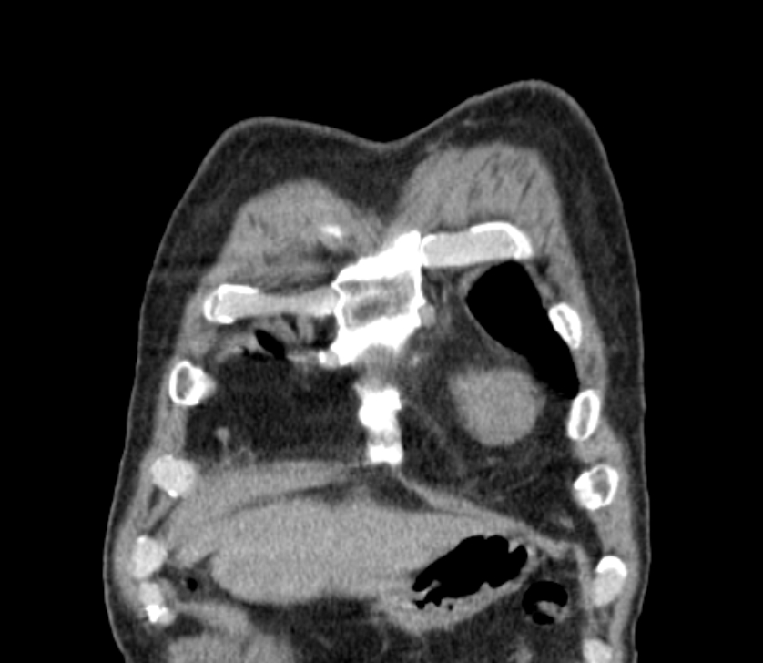 Airway foreign body in adult (Radiopaedia 85907-101779 Coronal liver window 18).jpg