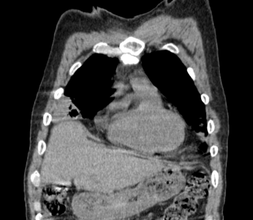 Airway foreign body in adult (Radiopaedia 85907-101779 Coronal liver window 47).jpg
