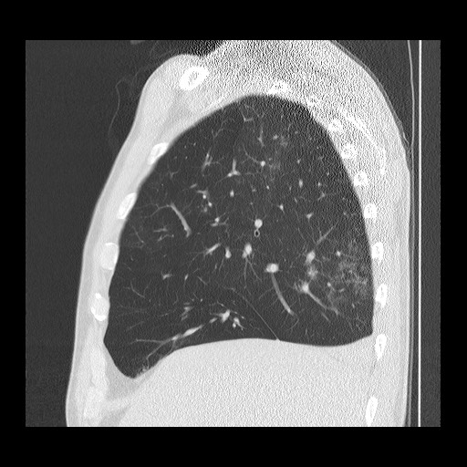 Allergic bronchopulmonary aspergillosis (ABPA) (Radiopaedia 60594-68313 Sagittal lung window 44).jpg