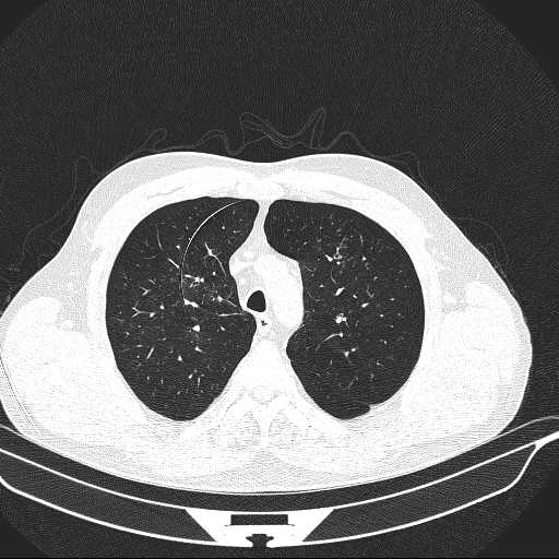 File:Allergic bronchopulmonary aspergillosis (Radiopaedia 21386-21320 Axial lung window 9).jpg