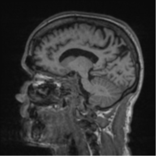 File:Alzheimer's disease- with apraxia (Radiopaedia 54763-61011 Sagittal T1 42).png