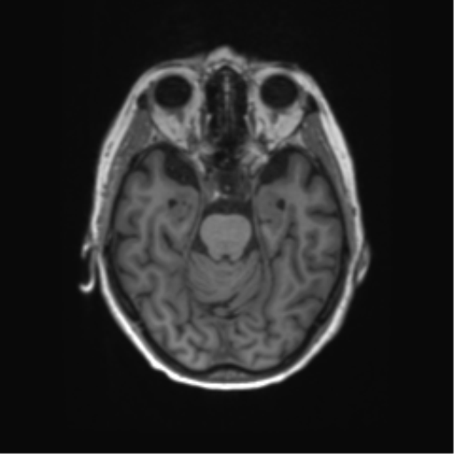 File:Alzheimer's disease (Radiopaedia 42658-45802 Axial T1 101).png