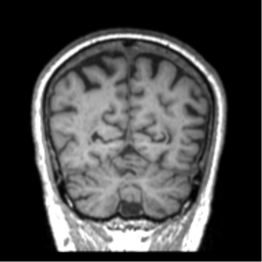 Alzheimer disease and cerebral amyloid angiopathy (Radiopaedia 64234-73011 Coronal T1 8).png