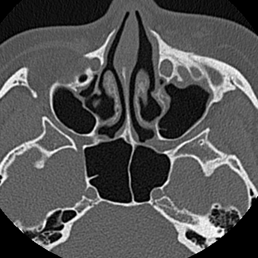 File:Ameloblastic fibro-odontoma (Radiopaedia 18843-18780 C 6).jpg