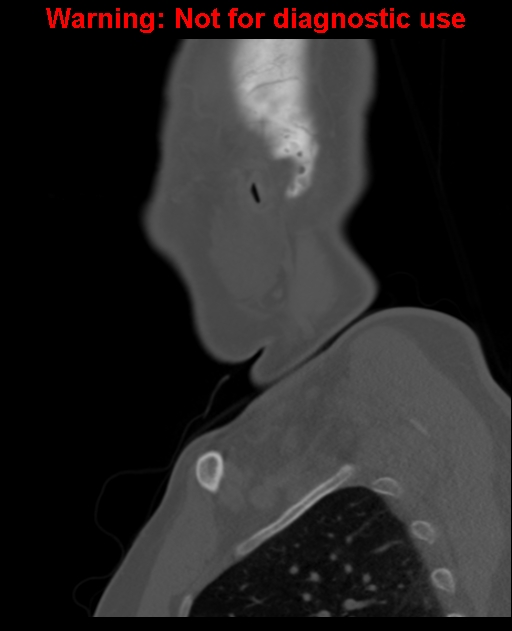 Ameloblastoma (Radiopaedia 33126-34164 Sagittal bone window 63).jpg