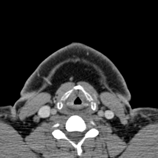 File:Ameloblastoma (Radiopaedia 33677-34806 Axial non-contrast 38).png