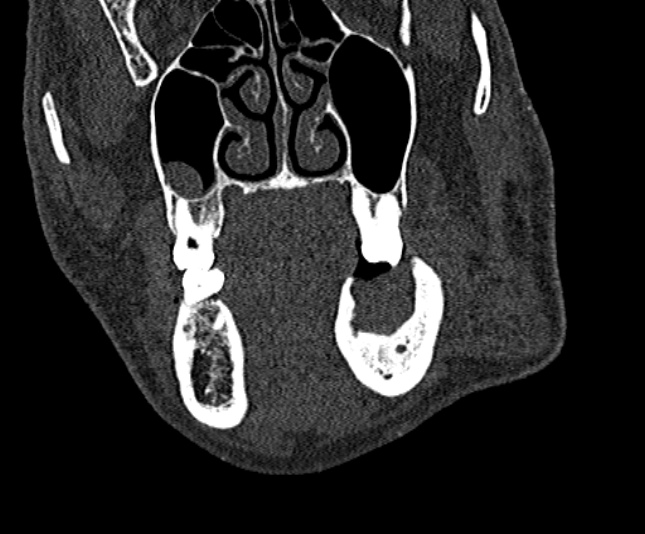 Ameloblastoma (Radiopaedia 51921-57766 Coronal bone window 80).jpg