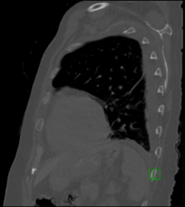Amiodarone deposition in the liver (Radiopaedia 77587-89780 Sagittal bone window 28).jpg