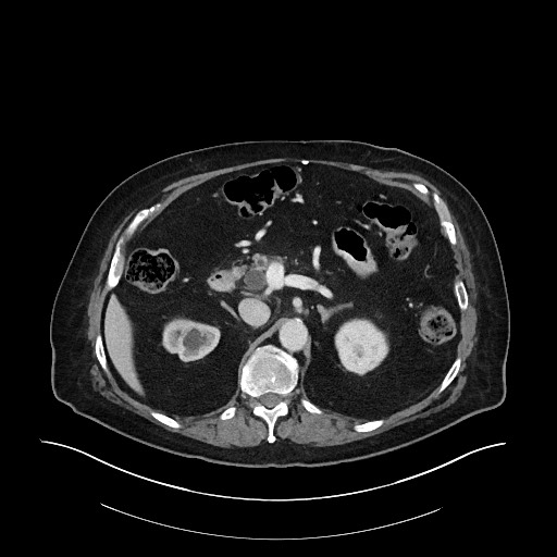 Ampullary adenocarcinoma (Radiopaedia 59373-66734 C 55).jpg