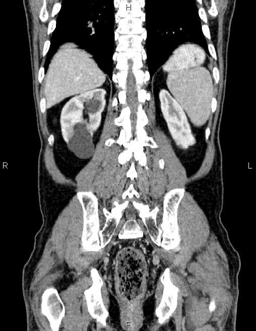 Ampullary adenocarcinoma (Radiopaedia 86093-102032 C 53).jpg
