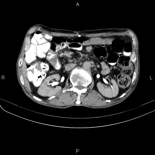 Ampullary adenocarcinoma (Radiopaedia 86093-102033 Axial C+ delayed 50).jpg