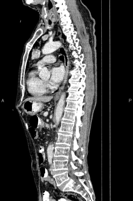 Ampullary adenocarcinoma (Radiopaedia 86093-102033 E 50).jpg