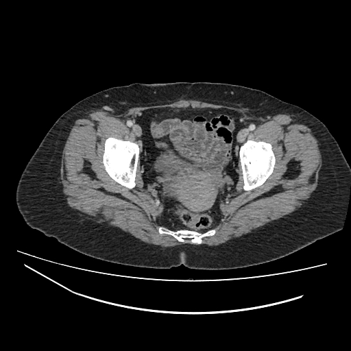 Ampullary tumor (Radiopaedia 60333-67998 A 82).jpg