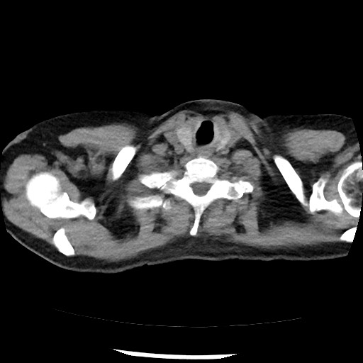 File:Amyloidosis - bronchial and diffuse nodular pulmonary involvement (Radiopaedia 60156-67744 Axial non-contrast 3).jpg