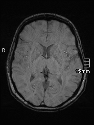 Amyotrophic lateral sclerosis (Radiopaedia 70821-81017 Axial SWI 27).jpg