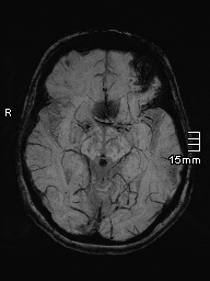 File:Amyotrophic lateral sclerosis (Radiopaedia 70821-81017 Axial SWI minIP 18).jpg