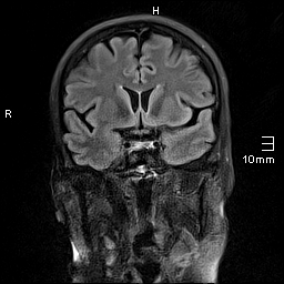 File:Amyotrophic lateral sclerosis (Radiopaedia 70821-81017 Coronal FLAIR 12).jpg